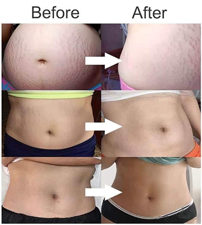 Stretch Mark Cream 120g/4 oz Stretch