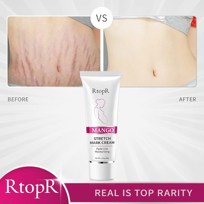 RtopR Mango Stretch Mark Cream Moisturizing