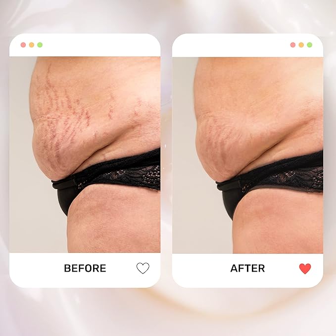 S1 Stretch Mark Cream, 150ml /