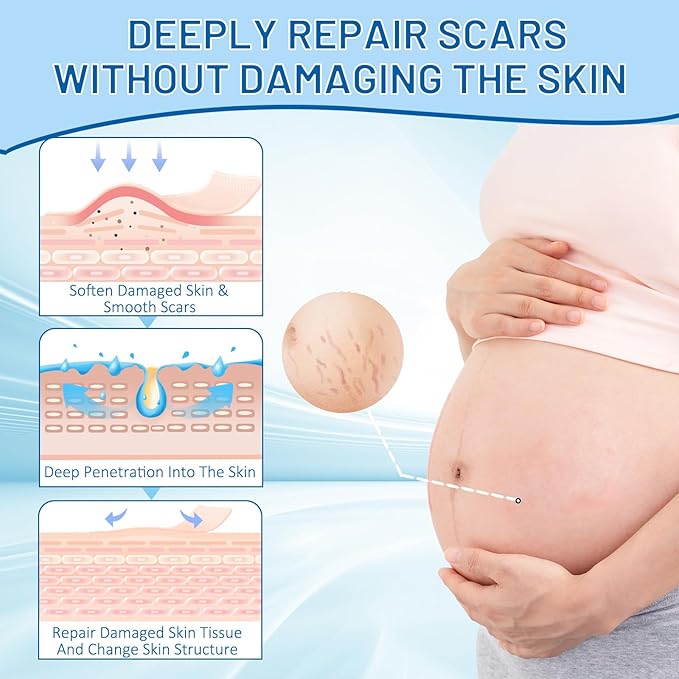 Stretch Mark Removal, Stretch Mark Cream