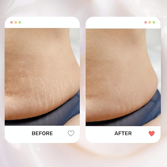 S1 Stretch Mark Cream, 150ml /
