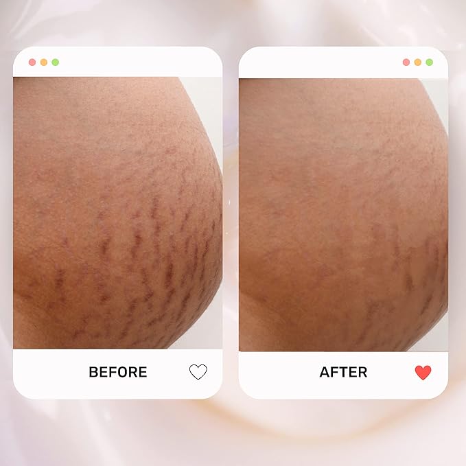 S1 Stretch Mark Cream, 150ml /