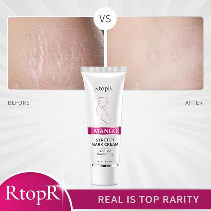 RtopR Mango Stretch Mark Cream Moisturizing