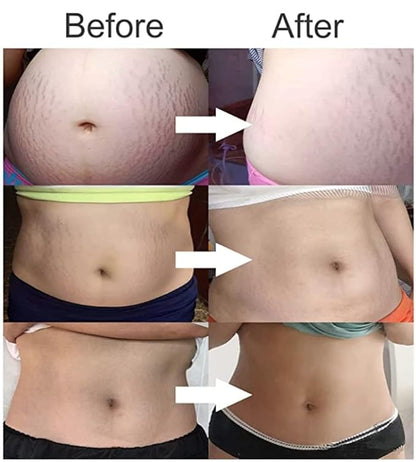 Stretch Mark Cream 120g/4 oz Stretch