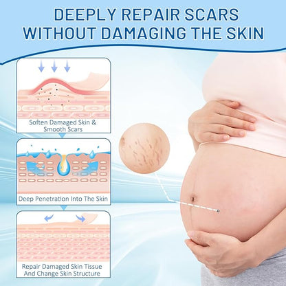 Stretch Mark Removal, Stretch Mark Cream